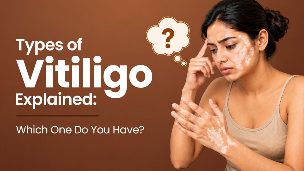 Types of Vitiligo Explained